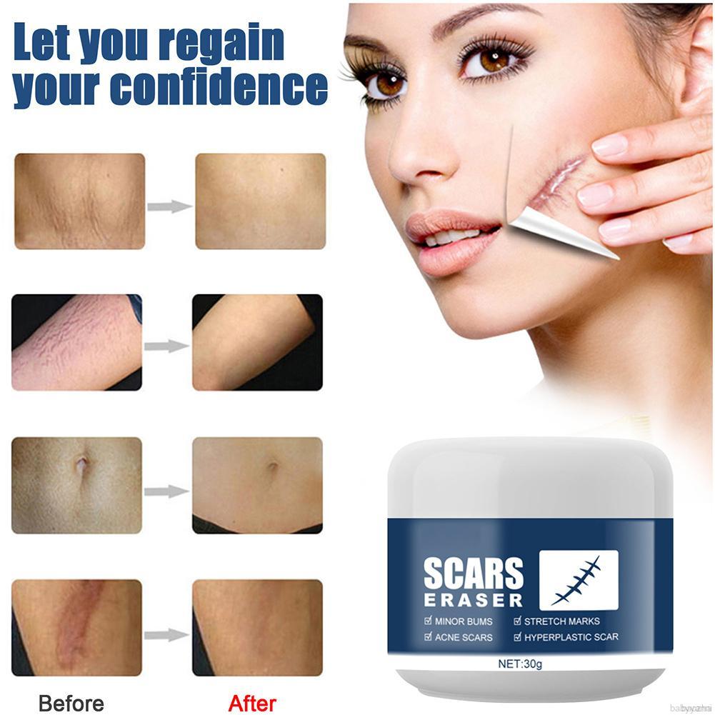 Multi-effect Scar Acne Cream Pimple Treatment Cream Scar Removal Cream- Stretch Marks Remover Cream For All Skin Types, New And