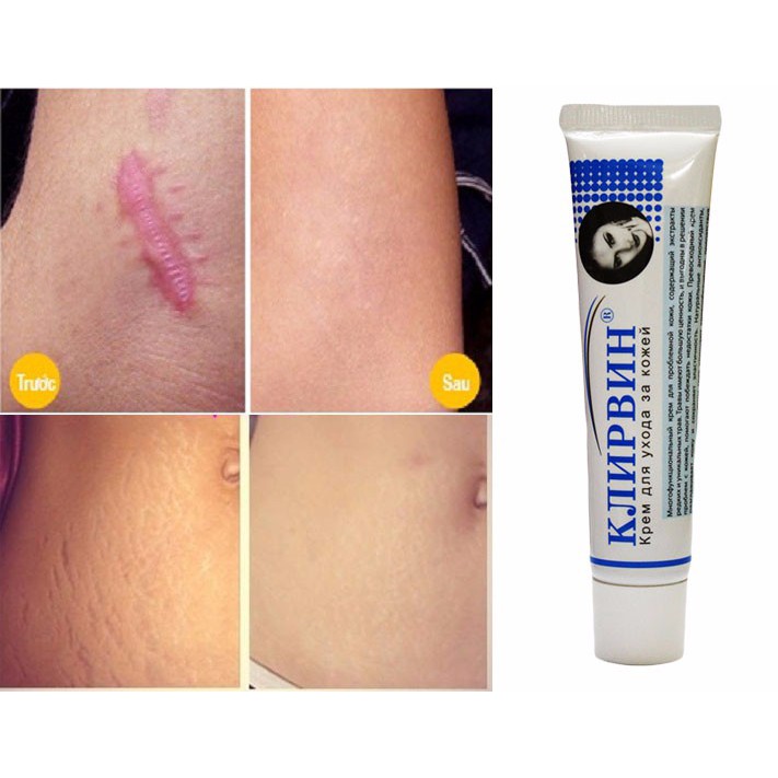 Kem Sẹo Nga Làm đều màu da