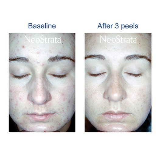 Tinh chất thay da sinh học NeoStrata ProSystem Retinol Peel