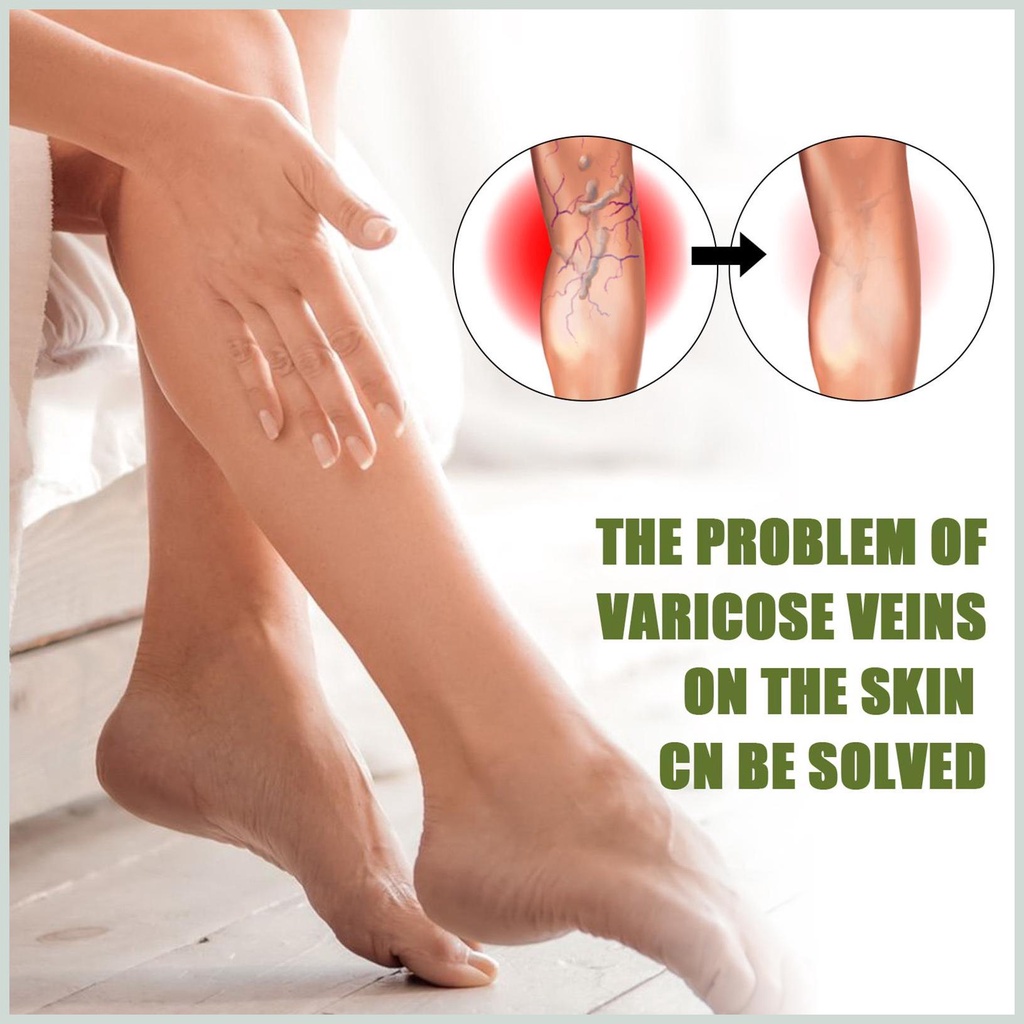 Kem Suy Giãn Tĩnh Mạch Perfect Skin 50g - Kem Varicose Vein Repair Cream Restore Thảo Dược Cải Thiện Tĩnh Mạch