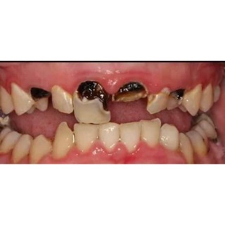 Tinh dầu chữa sún răng Lộc Phát Gia