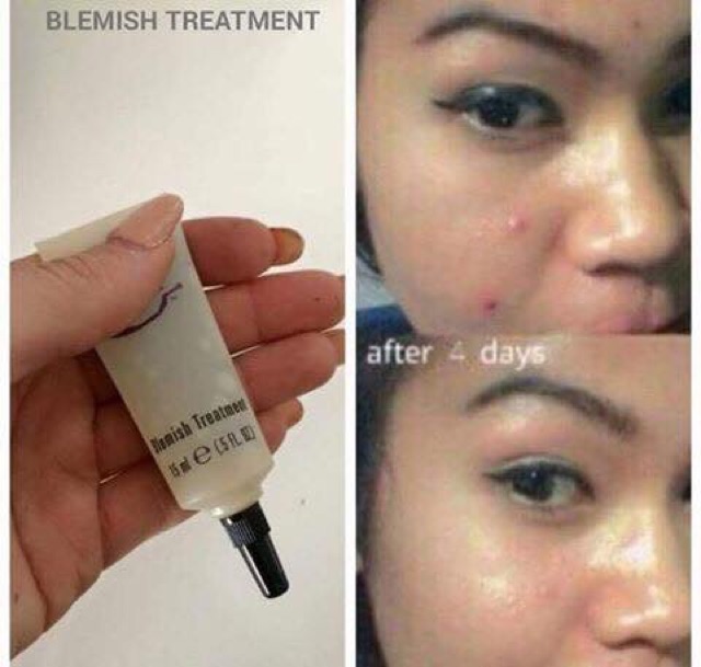 Kem giúp giảm mụn Epoch Blemish Treatment 15ml