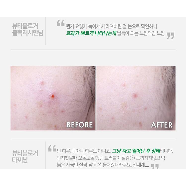 Miếng Dán Hỗ trợ giảm mụn Chăm Sóc Da Mặt ACROPASS