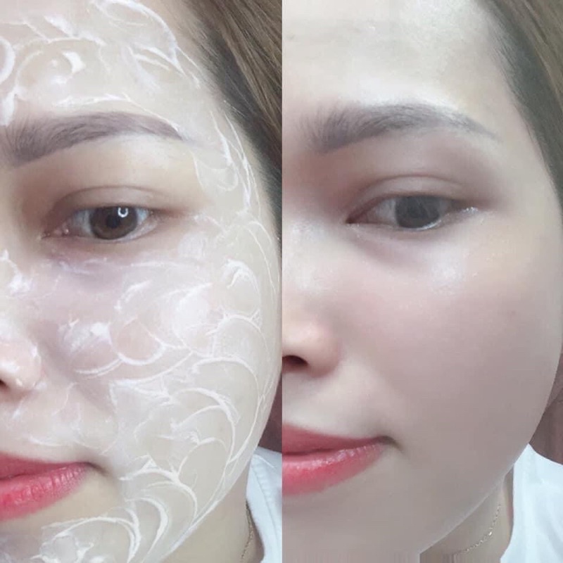 CẤY TRẮNG - dưỡng da , trẻ hoá da, bật tone 3-5 tone