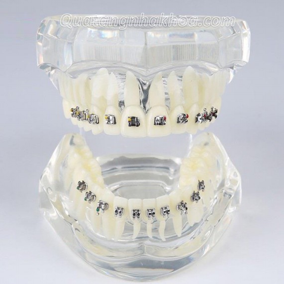 Mẫu hàm tư vấn chỉnh nha mắc cài kim loại – mô hình nắn chỉnh răng nha khoa
