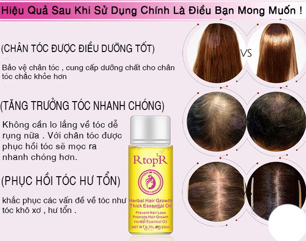 RtopR Dầu Tăng Trưởng Tóc Nhỏ Kích Mọc Tóc Nhanh Chóng &amp; Chăm Sóc Bảo Vệ Cho Tóc Chai 20ml