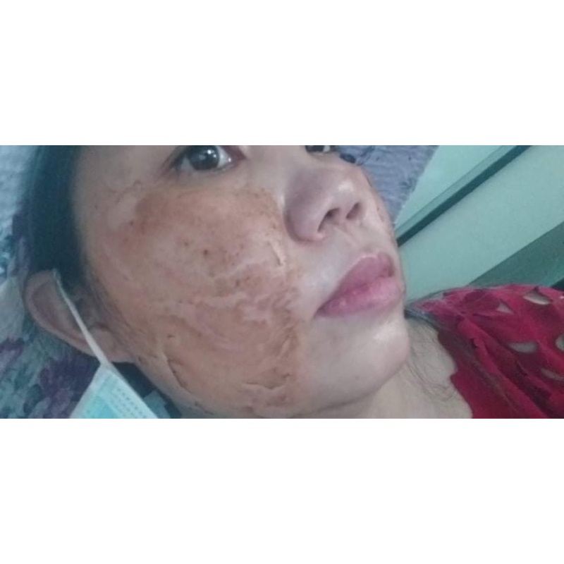 Combo phân giải nám mảng, tái tạo da Handmade