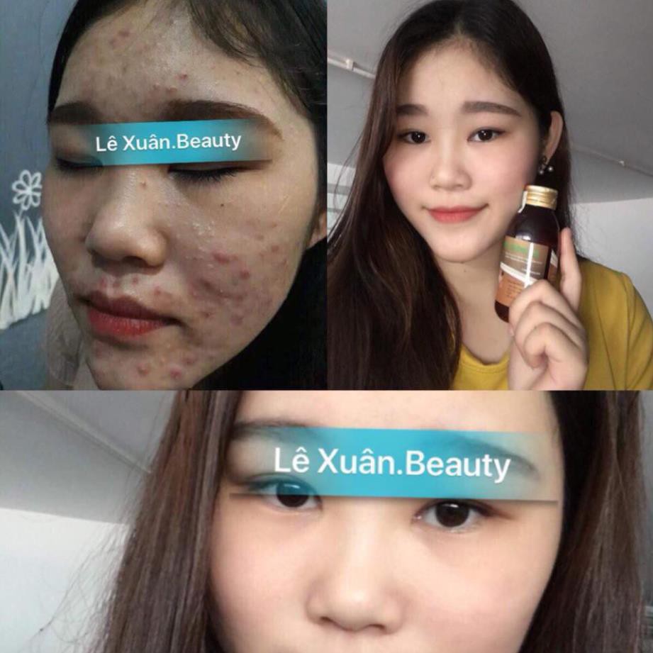 TINH CHẤT MỤN TRỨNG CÁ LÊ XUÂN💚FREESHIP💚Đánh bay mụn ẩn, mụn dầu đen, mụn trứng cá... sáng mịn da, khít lỗ chân lông | BigBuy360 - bigbuy360.vn