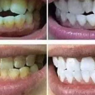 Bột trắng răng than hoạt tính Ashi (Răng trắng lên sau 2 tuần sử dụng sản phẩm) 😍 KÈM QUÀ HẤP DẪN