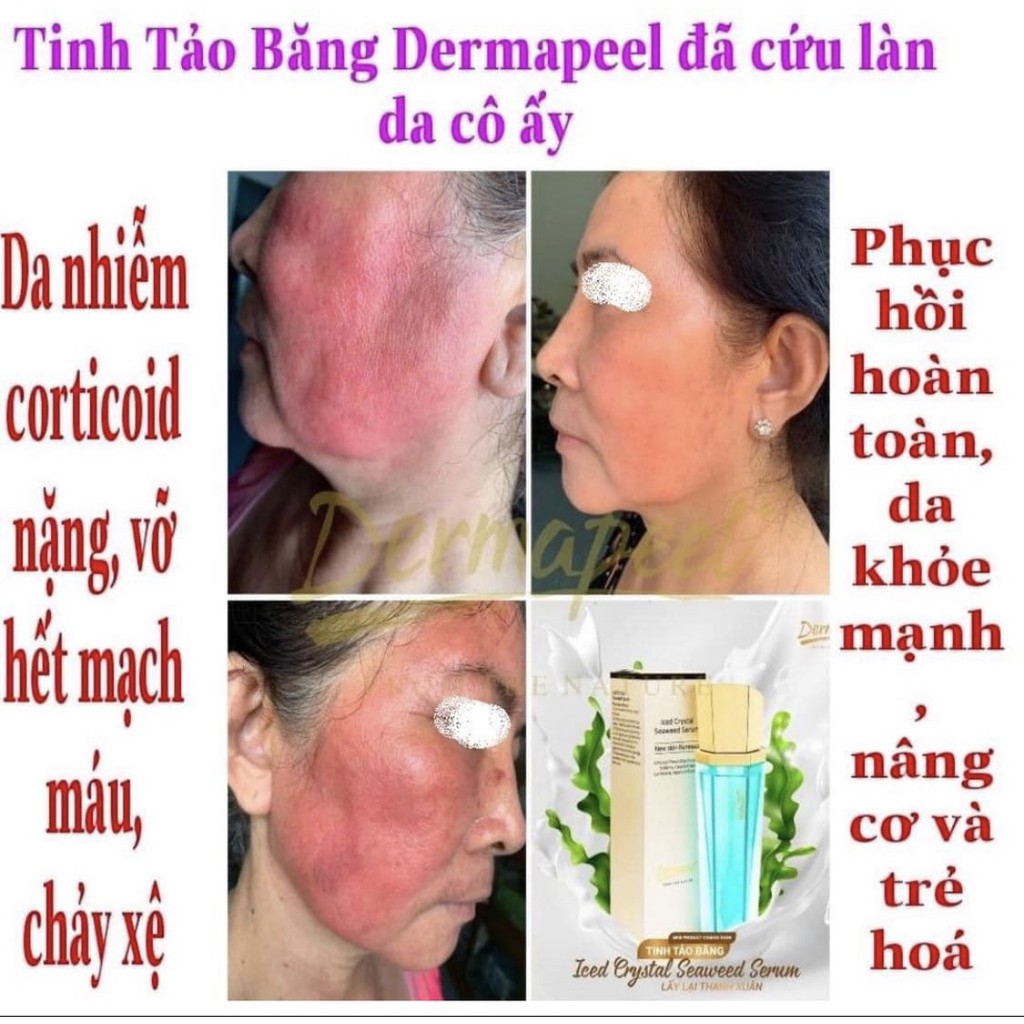 Dermapeel TINH TẢO BĂNG - ICED CRYSTAL SEAWEED SERUM - GIẢM TÌNH TRẠNG DA SƯNG ĐỎ NHANH CHÓNG - PHỤC HỒI DA HƯ TỔN