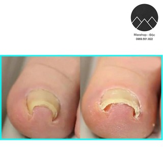Dụng cụ chữa móng chân chọc thịt - móng quặp thịt