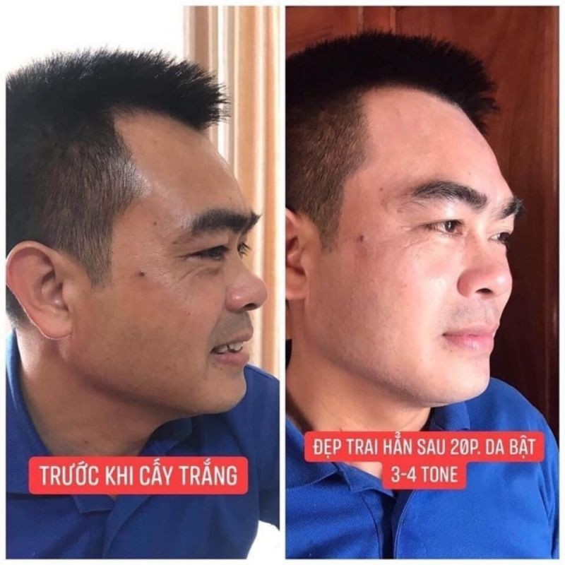 Tảo cấy trắng face Quin