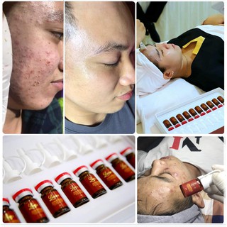 SERUM ACNE AMPOULE DNA CÁ HỒI (LOẠI BỎ MỤN TẬN GỐC)