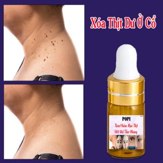 Kem Xóa Nốt Ruồi Mụn Thịt Tàn Nhang