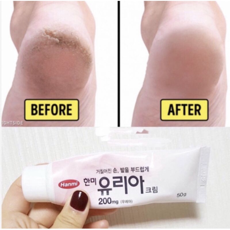 Kem Hỗ Trợ Giảm Nứt Gót Chân - Tay Urea
