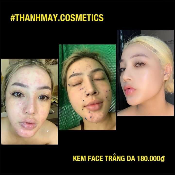 FACE THANH MÂY CHÍNH HÃNG 100% - FACE XÓA MỤN - GIẢM THÂM