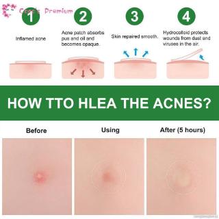ELAIMEI Coco Tea Tree Acne Patch Hydrocolloid Waterproof Clear Pimple Patch Acne Treatment Patch
