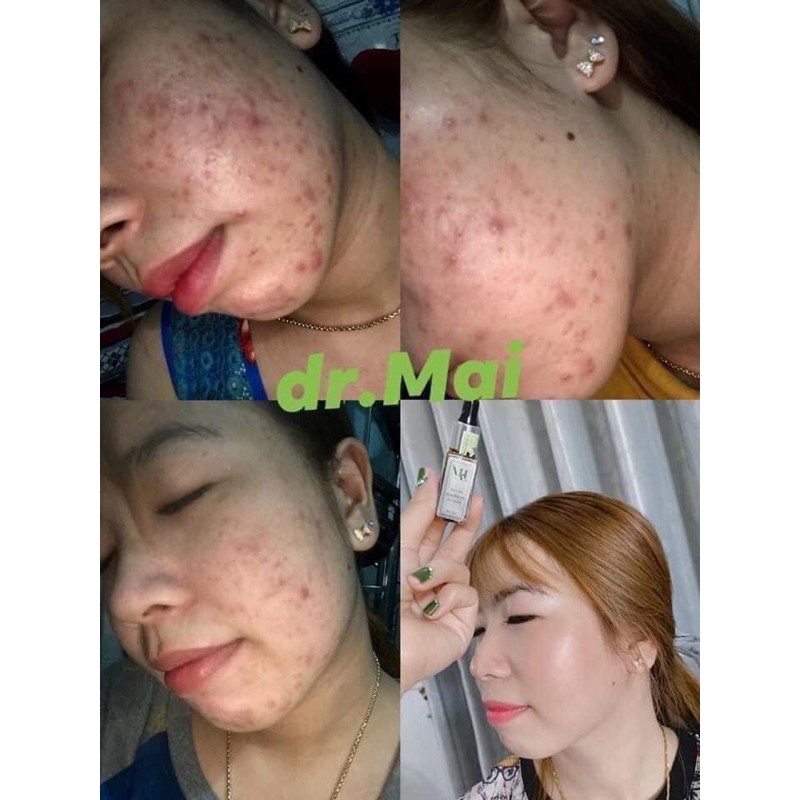 [Mẫu mới]Serum tri mụn dr mai xoá mụn giảm thâm