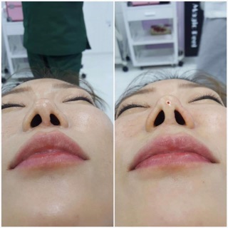 Chỉ Misko 26