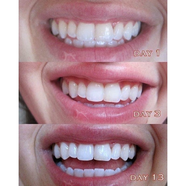 Date 2025  Set Tẩy Trắng Răng 60miếng Crest của Mỹ