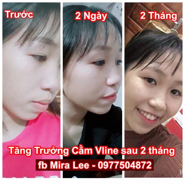 Tinh Chất Hàm Hô Vâu Miracle