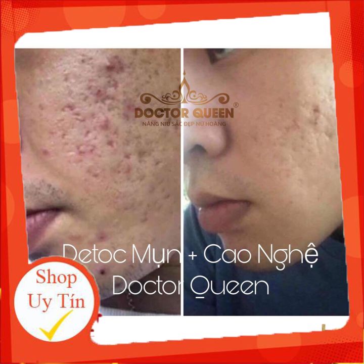 SERUM DETOX MỤN DOCTOR QUEEN 🔥NEW🔥 (Ngừa tất cả các loại mụn,thâm,đào thải phục hồi tái tạo da,da yếu, giãn mao mạch)