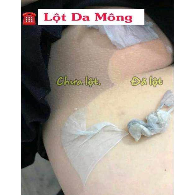 LỘT THAY DA MÔNG.HẾT THẰM MỜ RẠN.NỨT DA