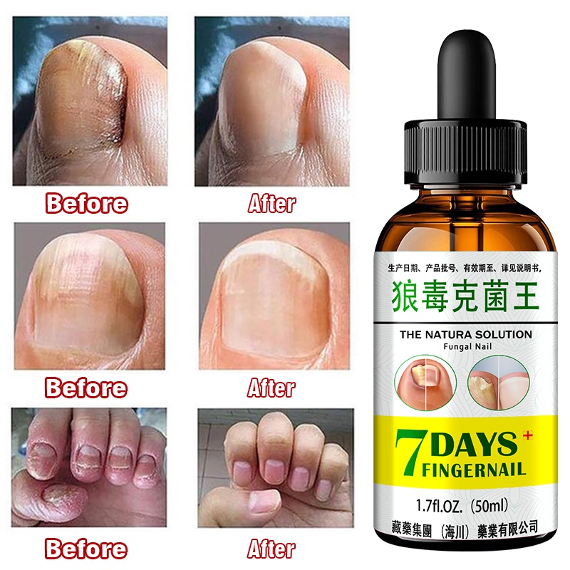 Tinh Chất Hỗ Trợ Giảm Bệnh Nấm Móng Chăm Sóc Móng Tay Tiện Dụng