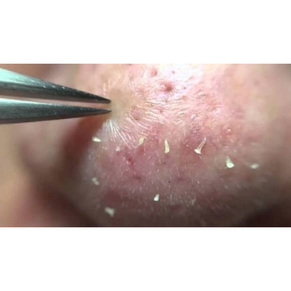 NHÍP GẮP MỤN ĐẦU ĐEN