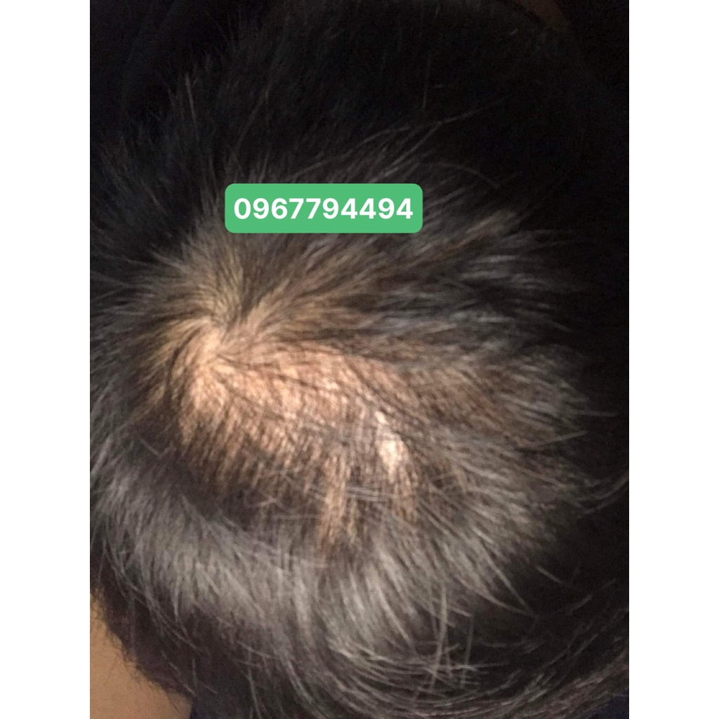 Mọc tóc Hair 4U Pro