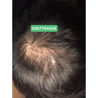Mọc tóc Hair 4U Pro