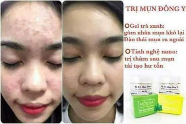 Bộ mụn thâm mocha dành cho tất cả các loại mụn