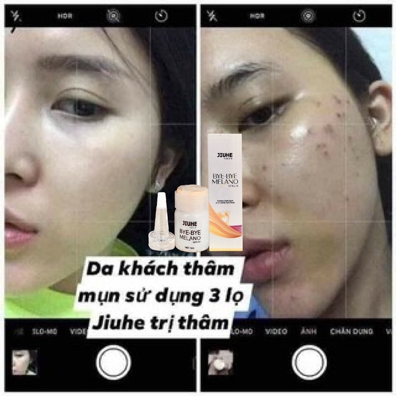 Serum tri thâm hàn quốc JIUHE Q-PEARL giảm thâm do mụn khửu tay chân, thâm sẹo, thâm nách hiệu quả | BigBuy360 - bigbuy360.vn