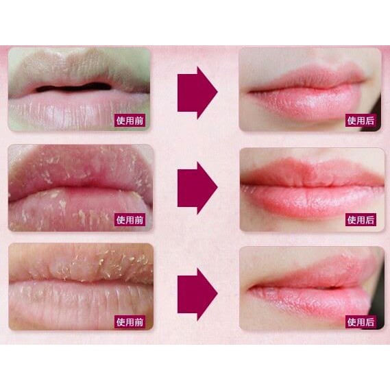 (hàng Mới Về) Mặt Nạ Môi Bổ Sung Collagen Nuôi Dưỡng Môi Recomend 2019 Bioaqua 100% | BigBuy360 - bigbuy360.vn