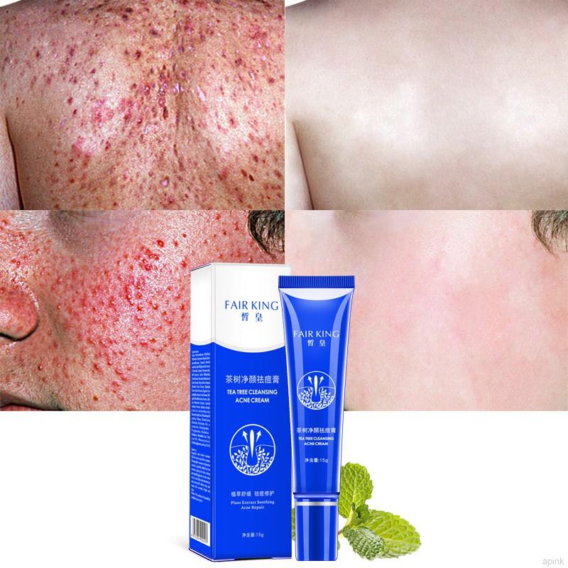 [Hàng mới về] Kem Giảm Mụn Chiết Xuất Trà Xanh Làm Sạch Da 15g