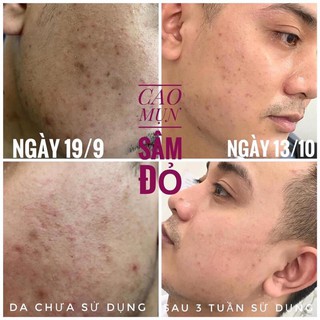 Cao Mụn Sâm Đỏ 36 V.i 5g - 15g