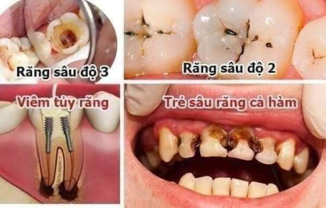 Tinh dầu Sâu răng hôi miệng Dạ Thảo Liên