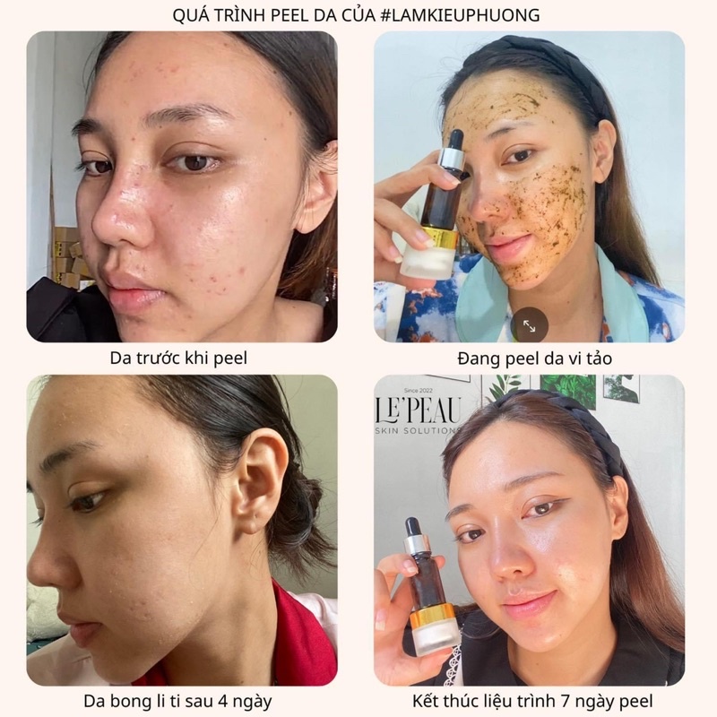 Peel mờ Thâm Mụn, Nám, Tàn Nhang, Sáng da - Tặng Serum B5 phục hồi da -  Peel da Vi Tảo Retinol - LE’PEAU