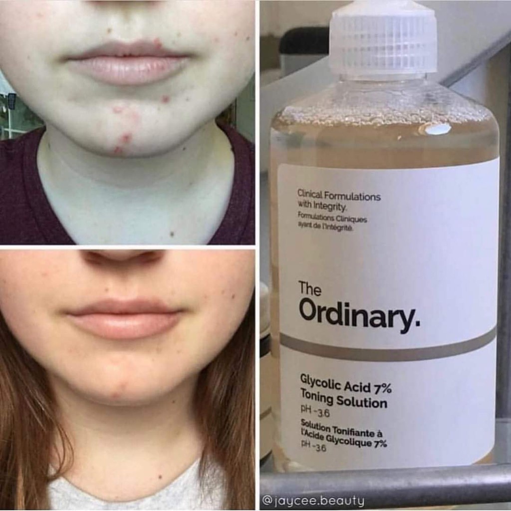 NƯỚC HOA HỒNG THE ORDINARY GLYCOLIC  ACID 7% TONING SOLUTION – 240ML (Bill Anh) | BigBuy360 - bigbuy360.vn
