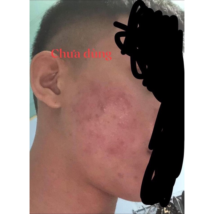 Tinh chất serum mụn thâm obaku | BigBuy360 - bigbuy360.vn