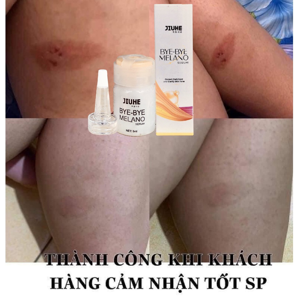 Serum thâm jiuhe, thâm mụn cho da dầu,tinh chất  thâm nám ,thâm môi,thâm mắt,thâm vùng kín,