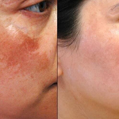 Cao nám Whoo Radiant White Ultimate Correcto giúp mờ các vết thâm sạm nám, tàn nhang dưỡng trắng đều màu da - vỉ 1ml