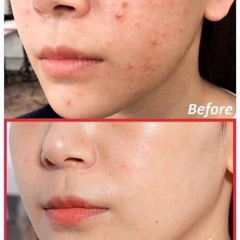 Kem Dưỡng Dạng Gel Cấp Ẩm Chăm Sóc Da Mụn, Mờ Thâm, Sẹo Derladie Witch Hazel Perfect Vitamin Gel Cream 55ml