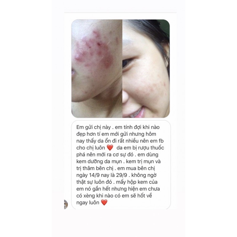 Combo kem thâm & mụn handmade Sunday Beauty