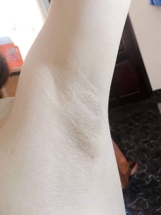 Triệt lông was shinny