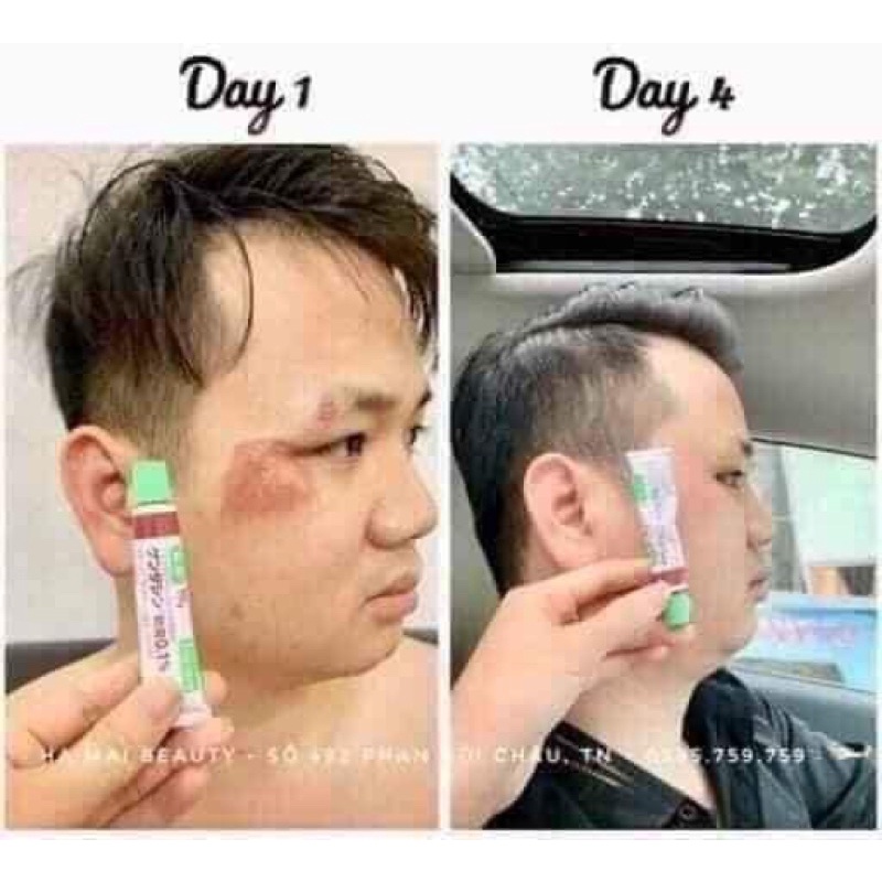 Kem sẹo Nhật gentamicin 10g