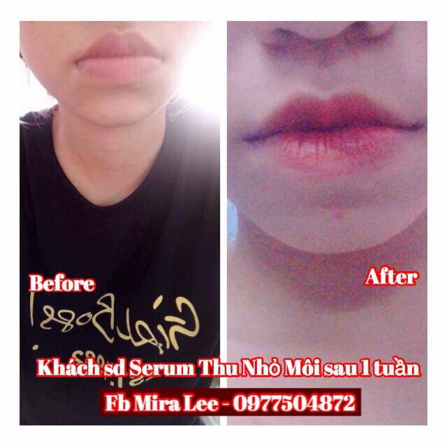 Tinh Chất Thu Nhỏ Môi Miracle