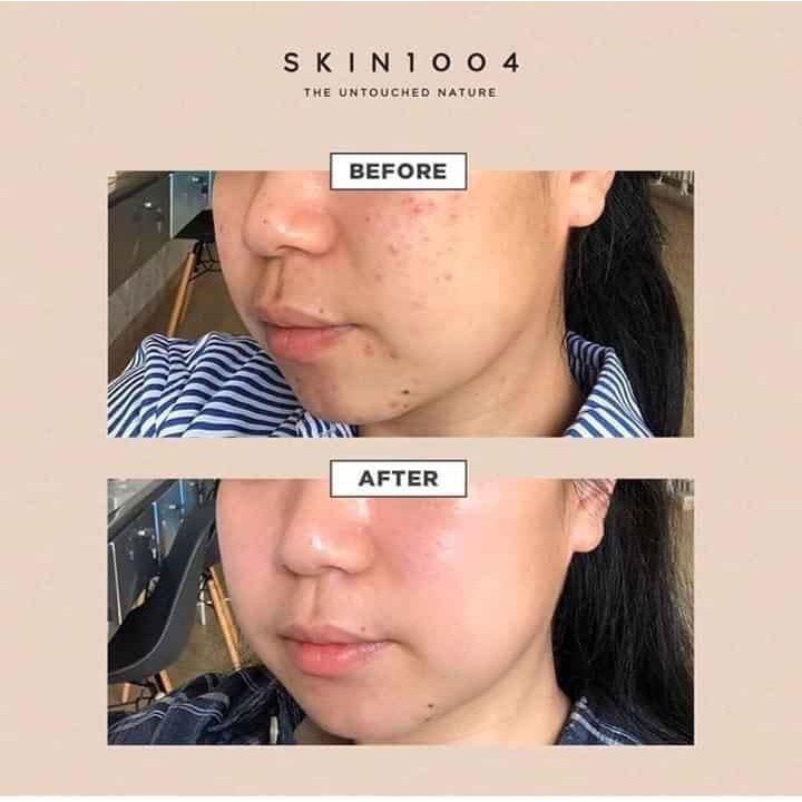 Combo Giảm Mụn, Phục Hồi Da Chiết Xuất Rau Má Skin1004 Madagascar Centella (Toner 210ml + Serum 100ml )