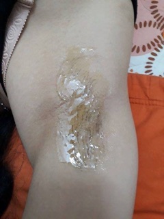 Combo triệt lông wax + mỡ trăn