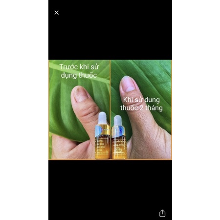 Liệu trình phục hồi nấm móng, hư khoé, bọng móng nước ăn chân.
